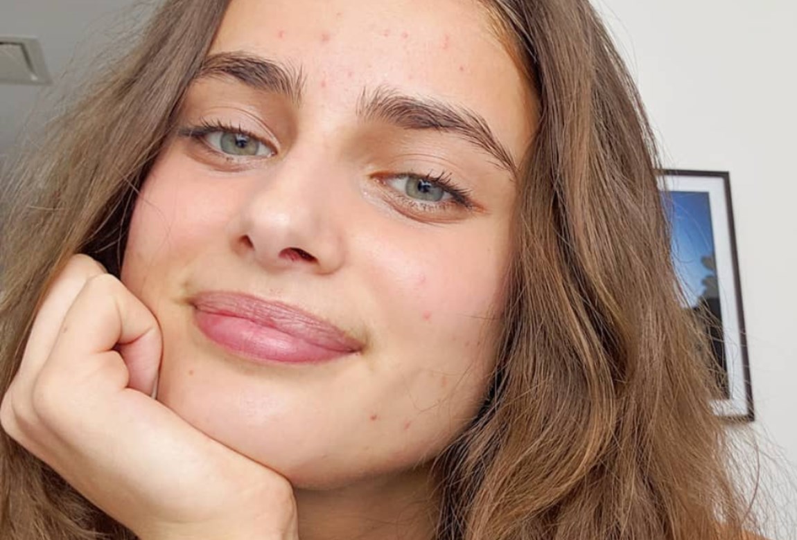Models That Have Been Open About Their Acne Struggles | BEAUTY/crew