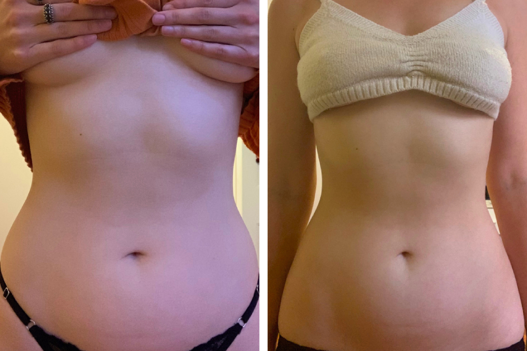 Abs Without Exercise I Tried A Body Sculpting Treatment That Does